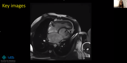 Left Ventricular Apical Hipoplasia, report of a case